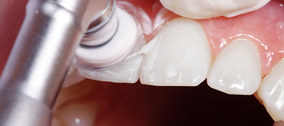 歯と歯肉の間・歯の表面の清掃